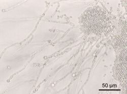 Symptoms of Candida